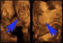Ecografia bebe 3D
